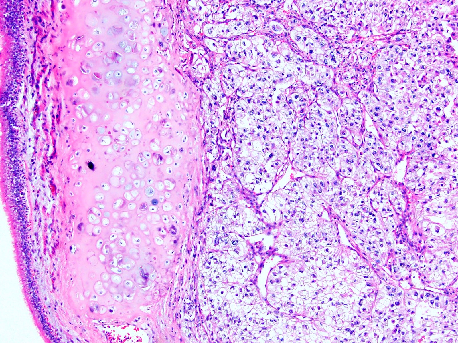 Renal cell carcinoma metastasis to bronchus (pM)