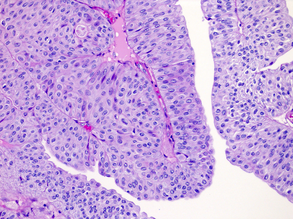 Noninvasive papillary urothelial carcinoma, low grade (pTa)