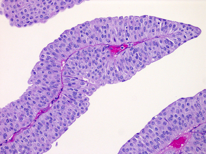 Noninvasive papillary urothelial carcinoma, low grade (pTa)