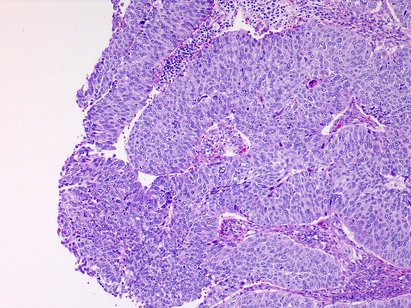 Noninvasive papillary urothelial carcinoma, high grade (pTa)