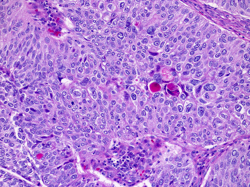 papillary urothelial neoplasm icd 10