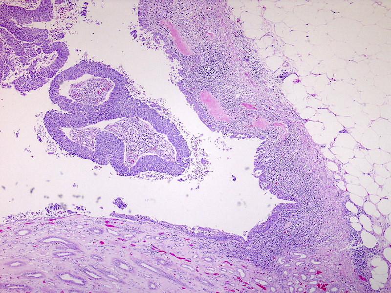Papillary urothelial<br>carcinoma, muscularis<br>is absent