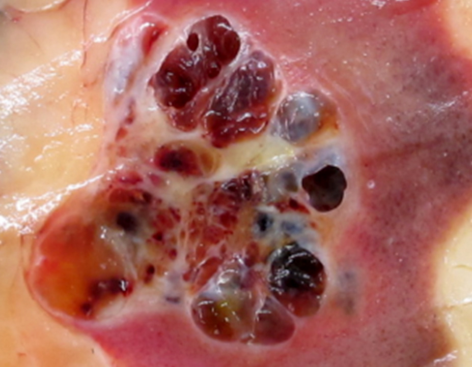 Irregular tumor pushing into renal hilum