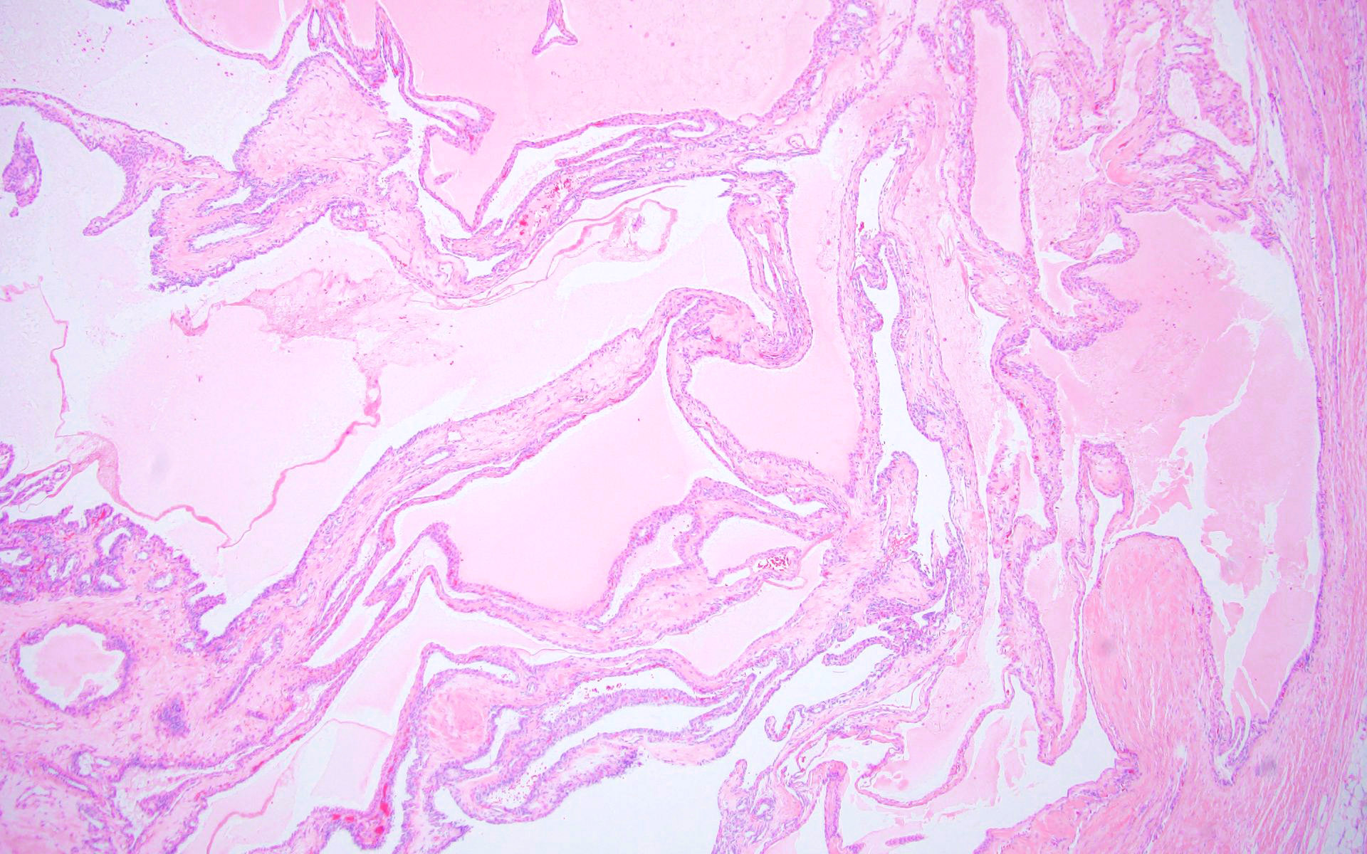 Variably sized cysts with low grade clear cell lining