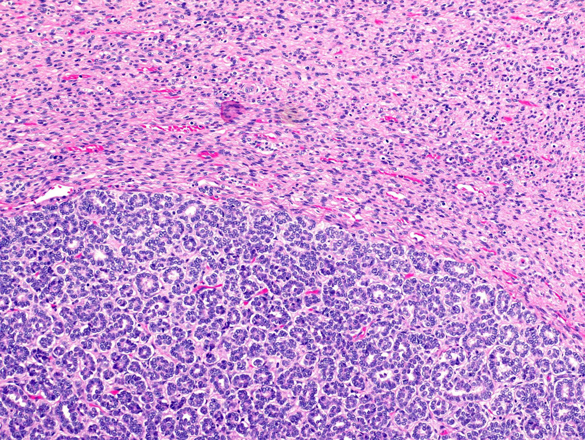 Biphasic tumor with epithelial and stromal components