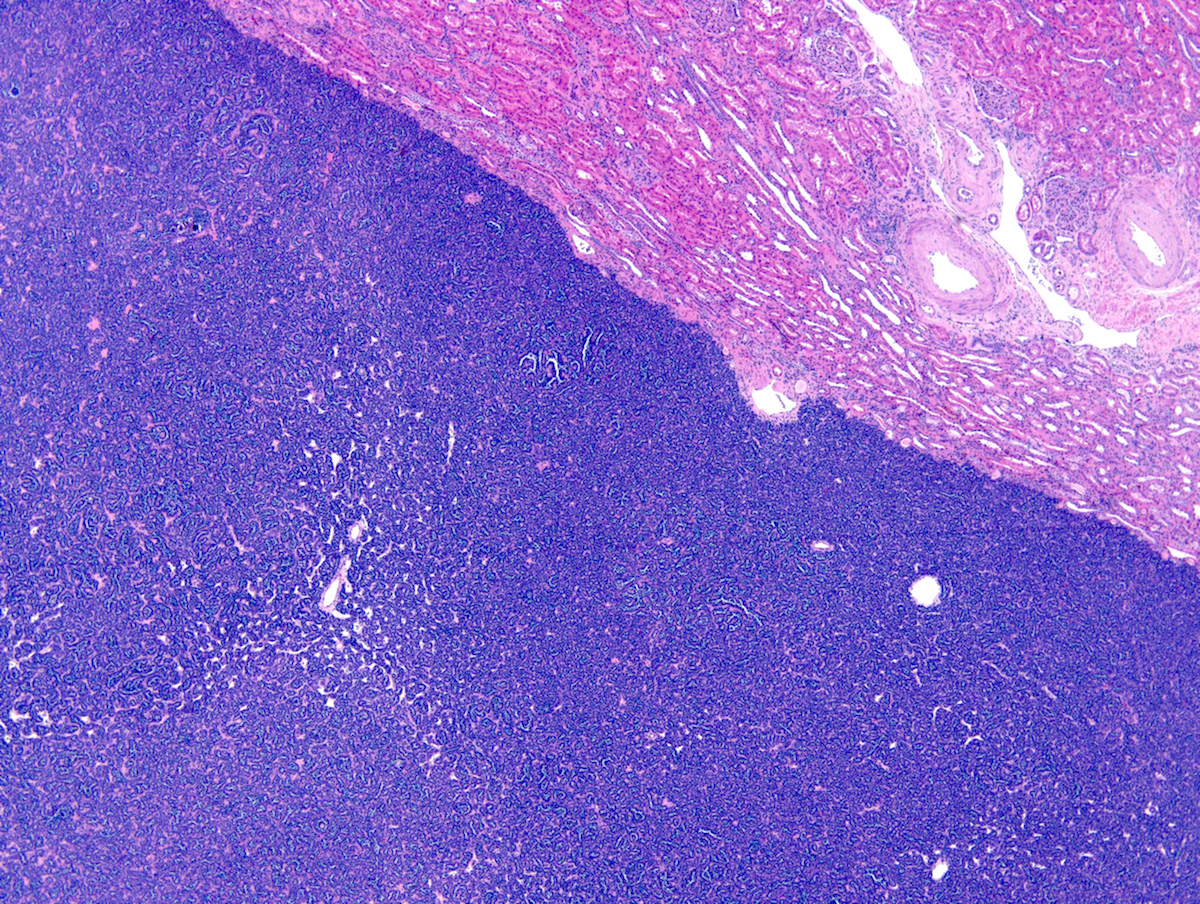 mesonephric adenoma pathology outlines