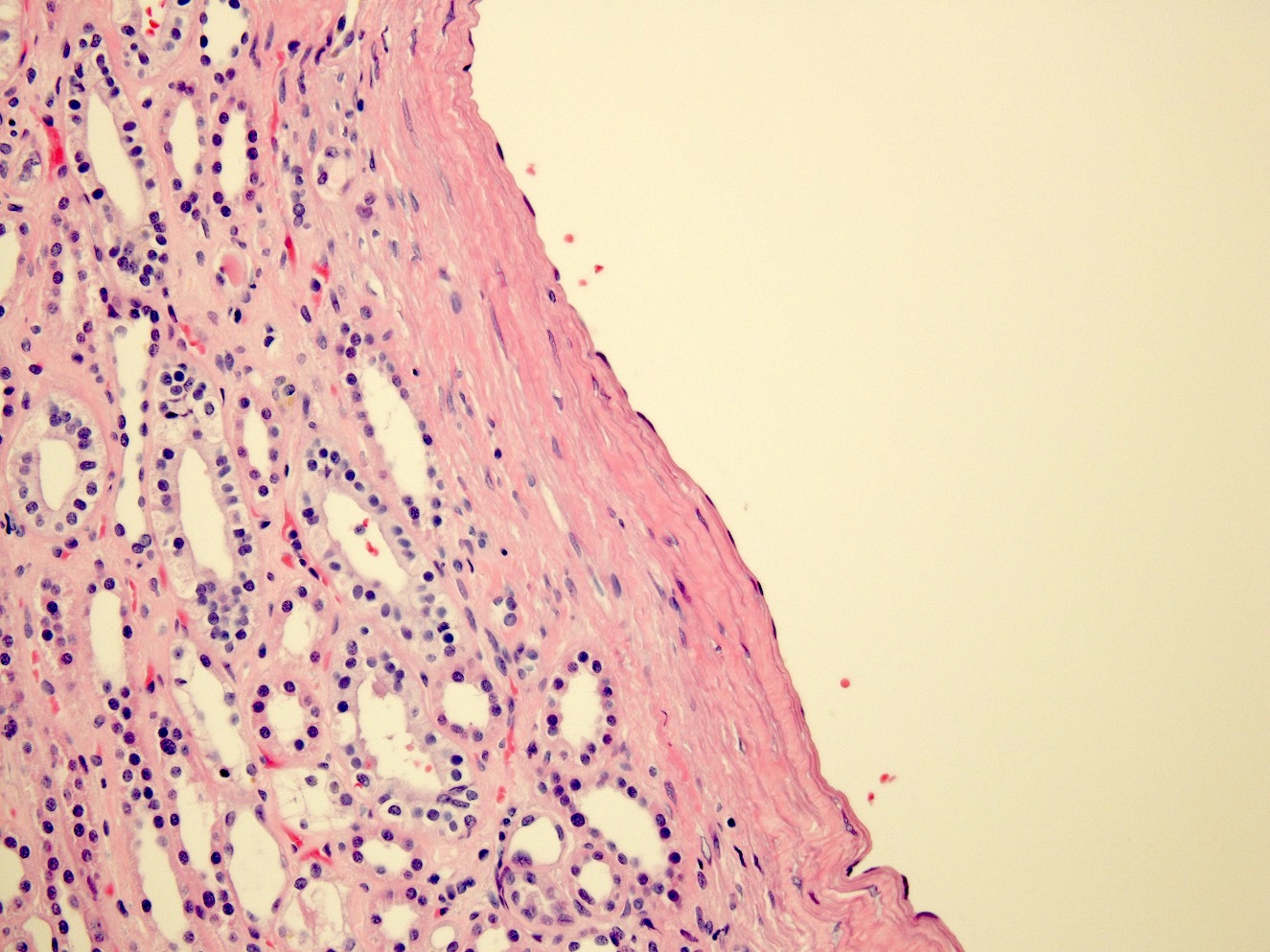 Flattened cyst wall epithelium