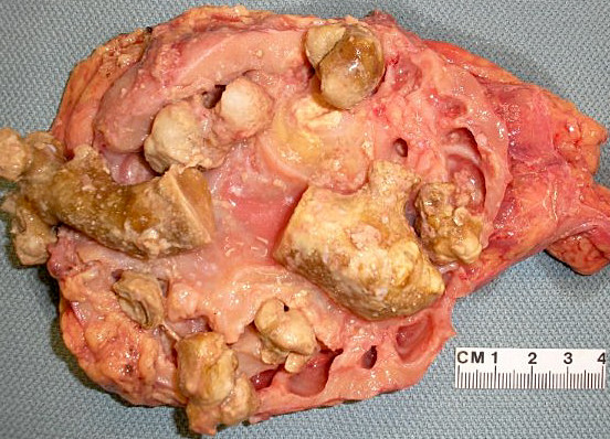 Multiple kidney stones