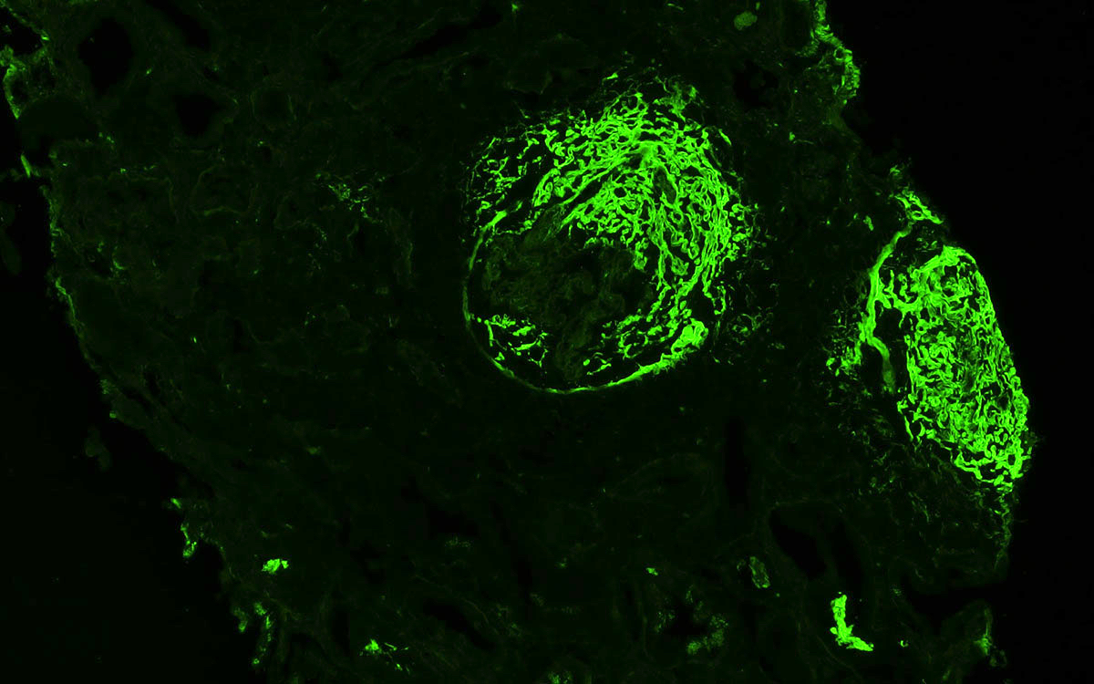 Fibrin in glomerular crescents