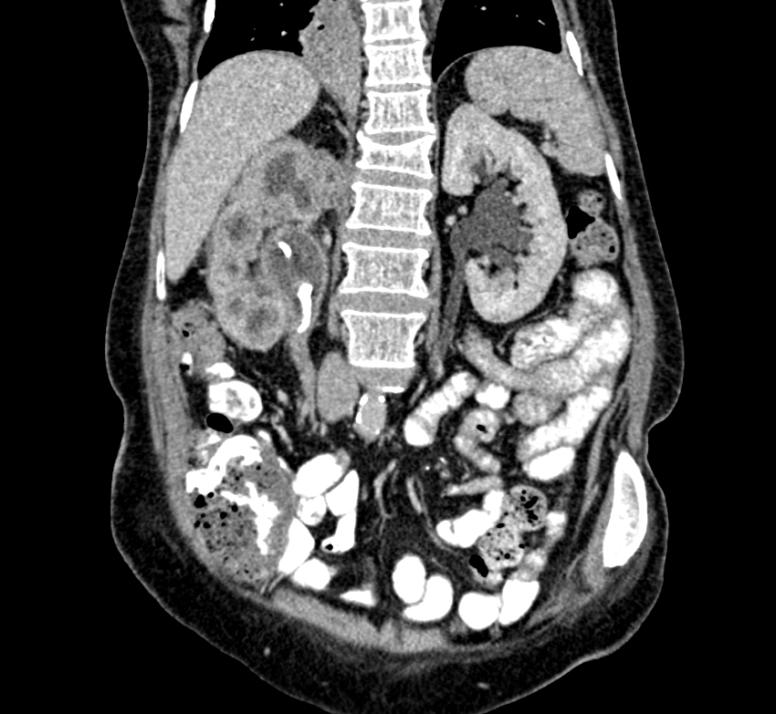 Dilated renal pelvis on CT