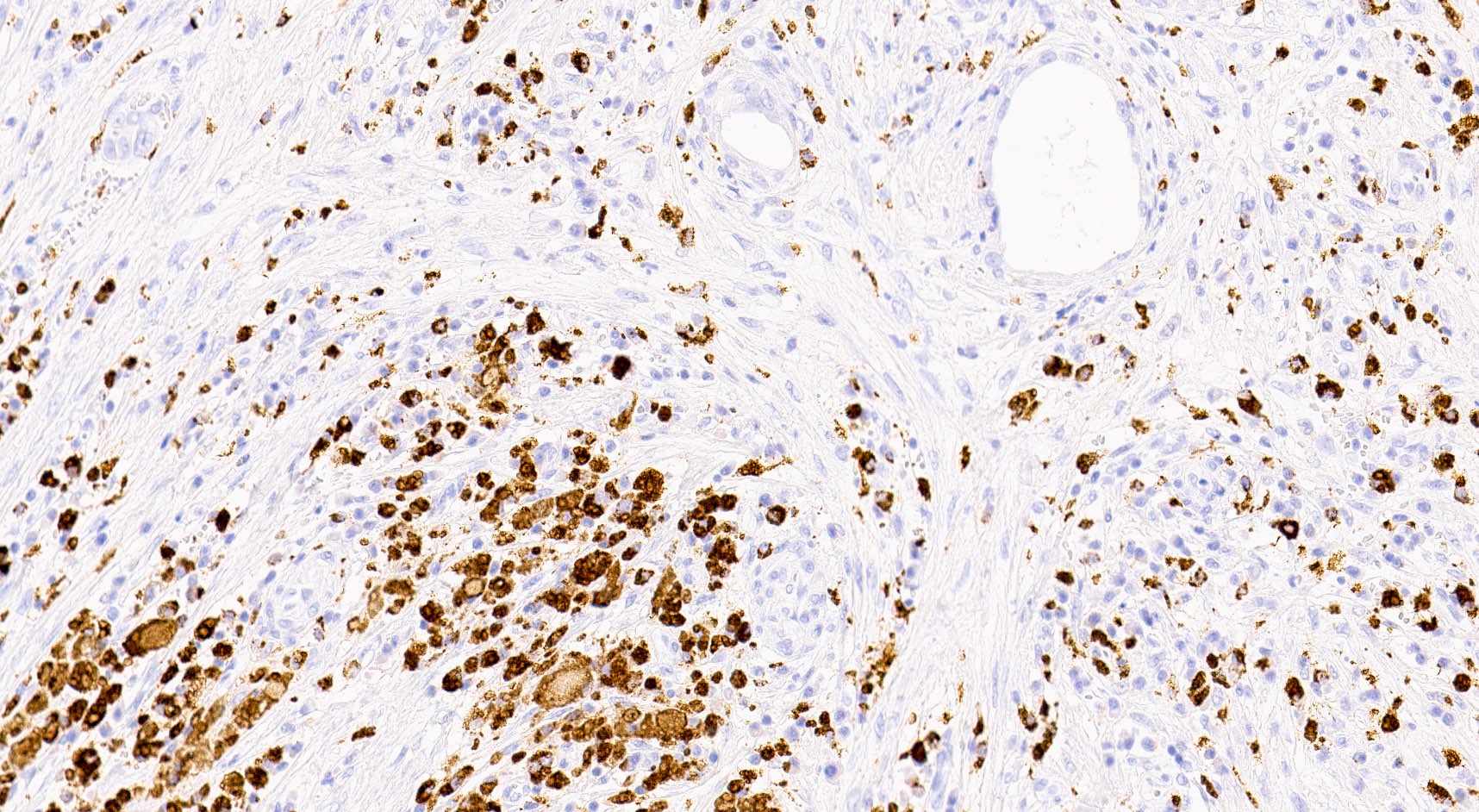CD68+ macrophages (xanthoma cells)