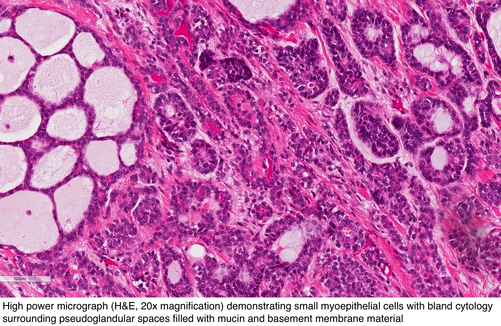 adenoid cystic carcinoma pathology