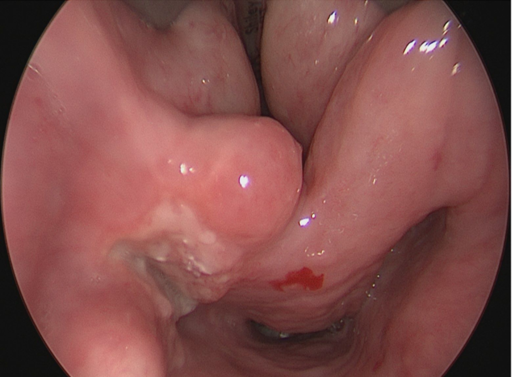 Ulcerated hypopharyngeal lesion