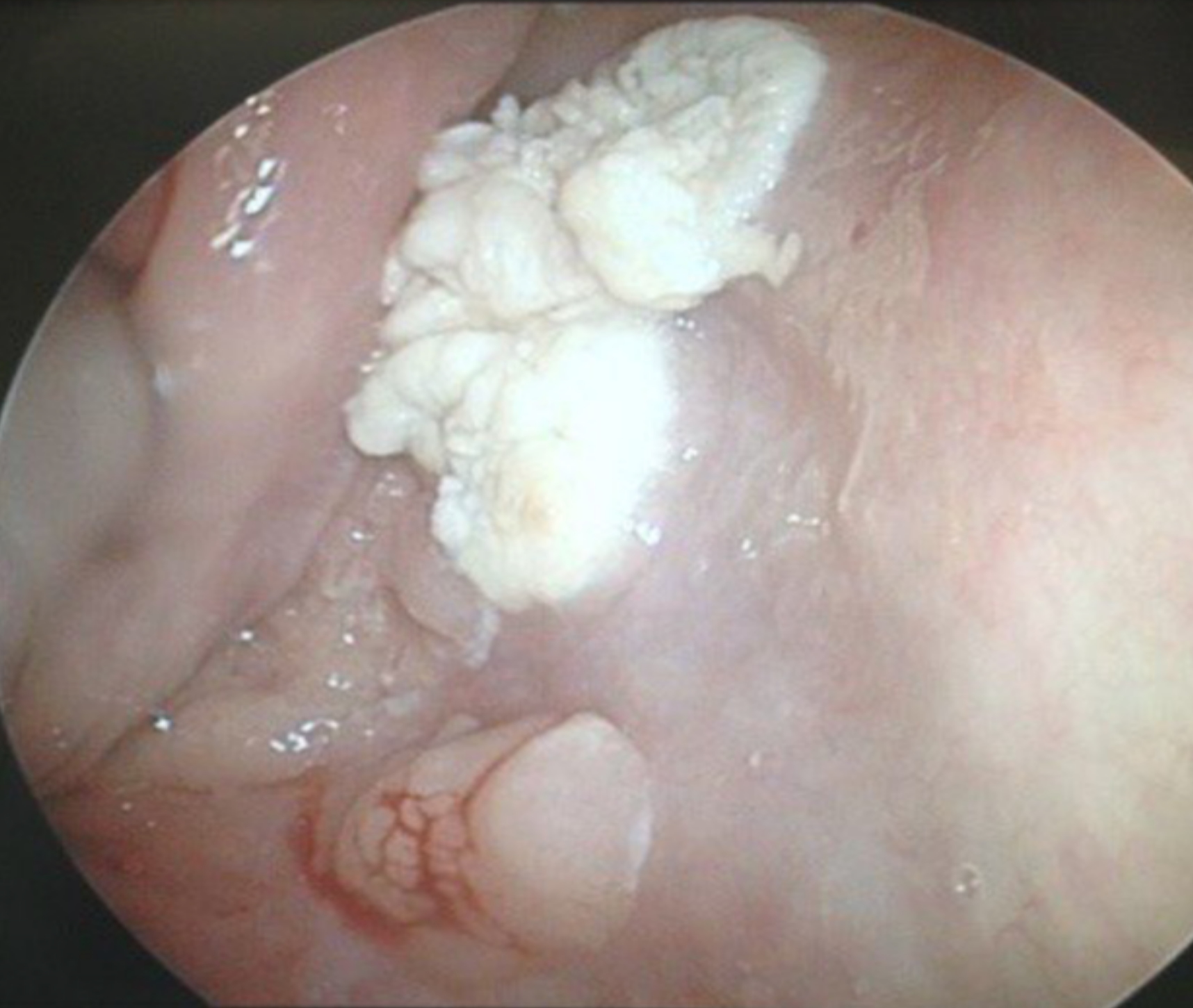 Keratotic hypopharyngeal lesion