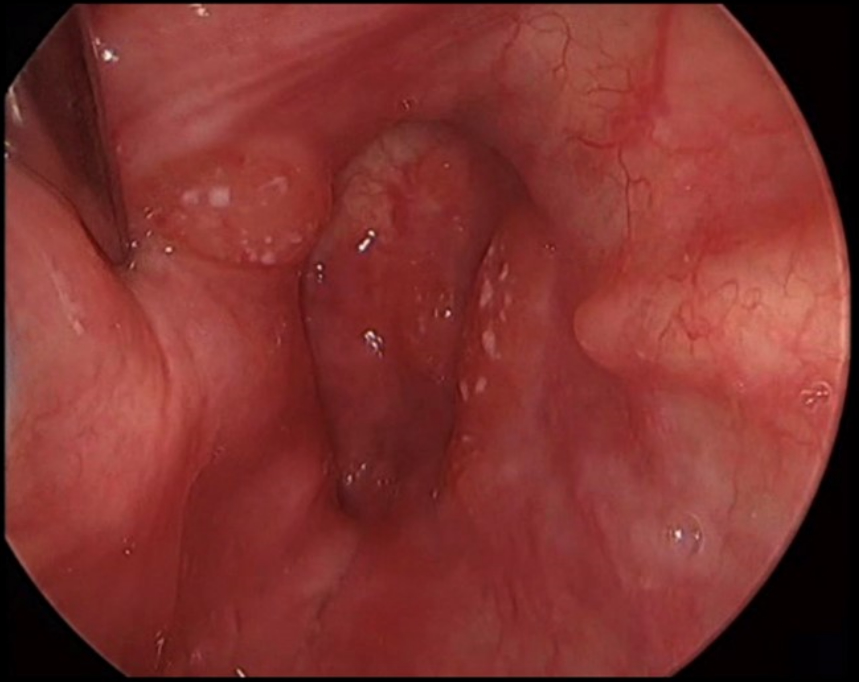 Polypoid ulcerated hypopharyngeal lesion