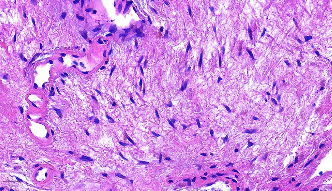 Fibroblastic myxoid stroma