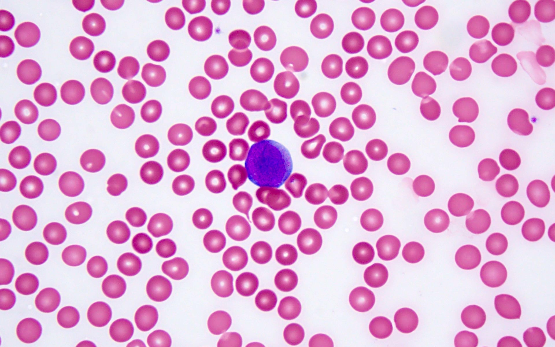 Pathology Outlines - AML without maturation (FAB AML M1)
