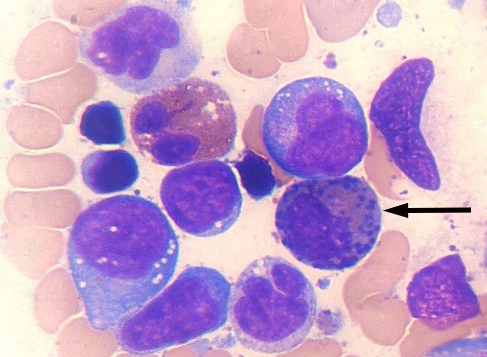 Abnormal eosinophilic cell