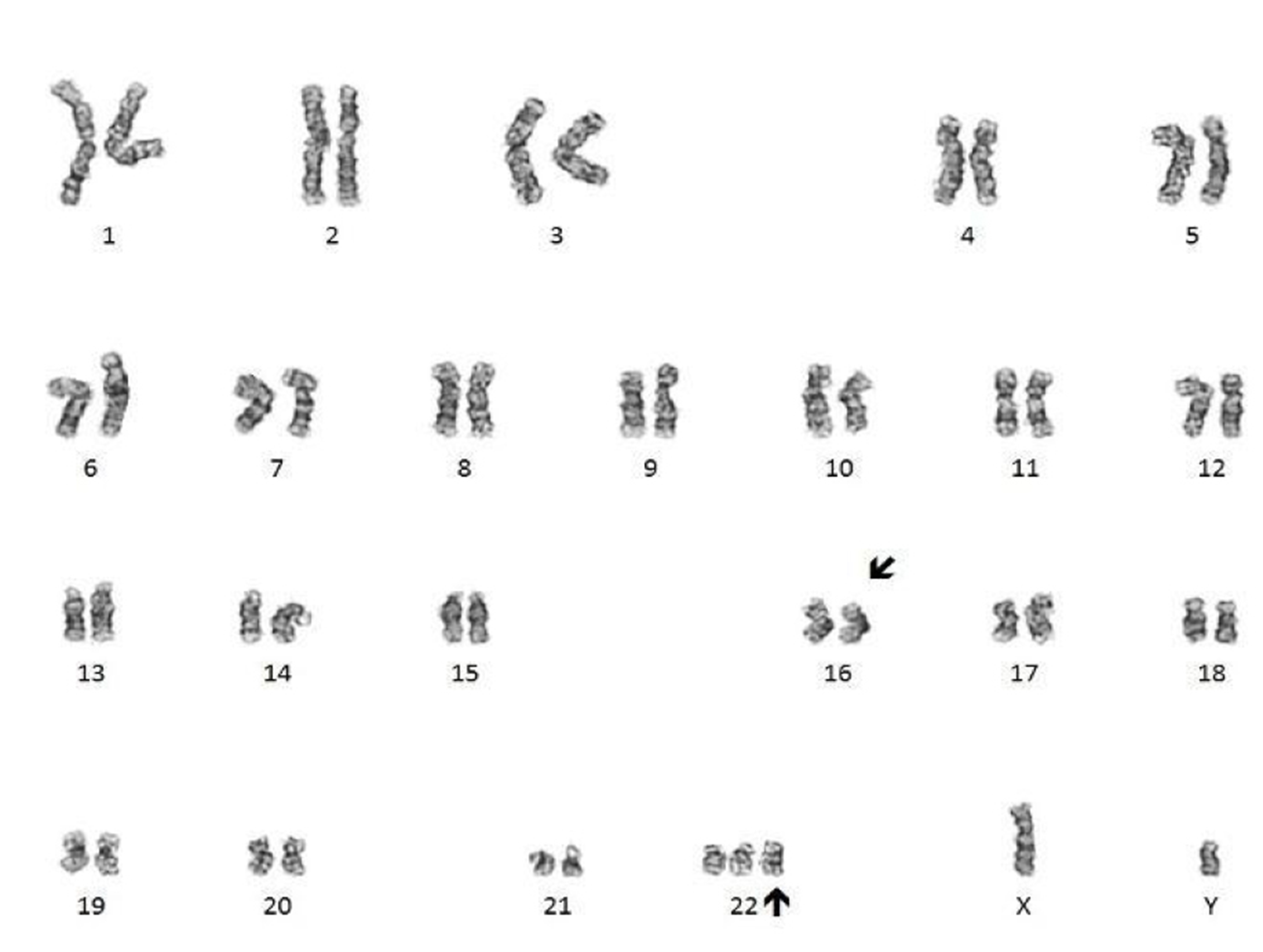 Inversion of chromosome 16