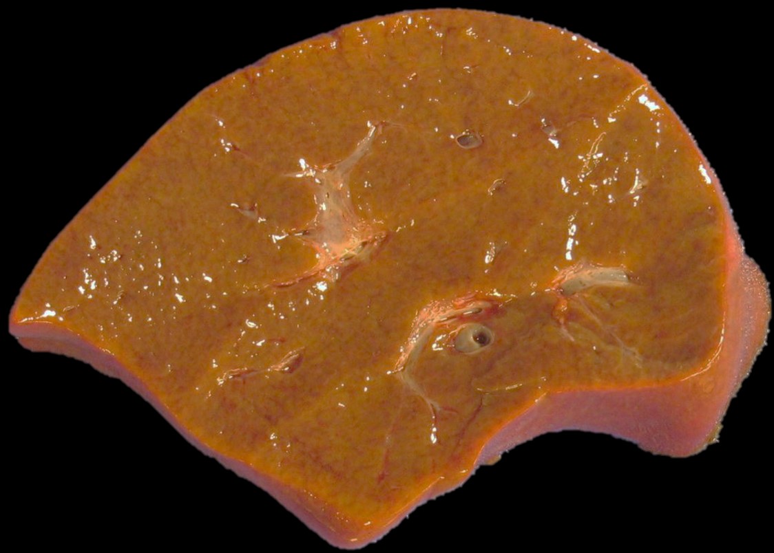Nutmeg liver