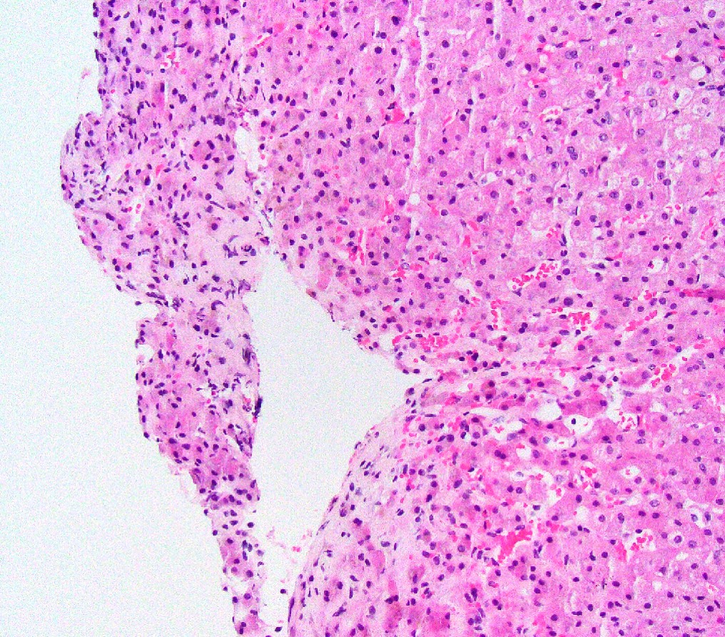 Centrilobular hepatocyte atrophy