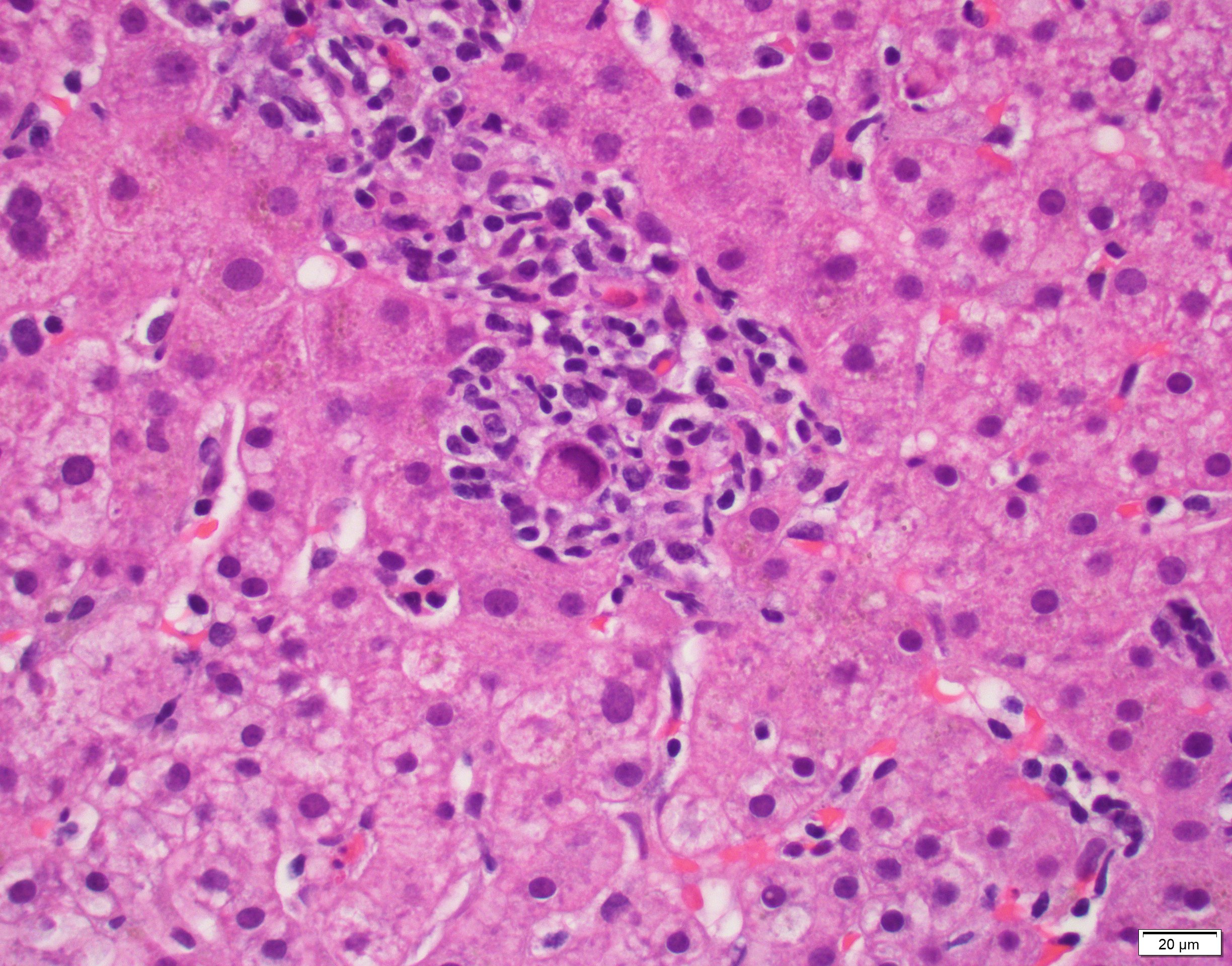 Pathology Outlines Cytomegalovirus hepatitis