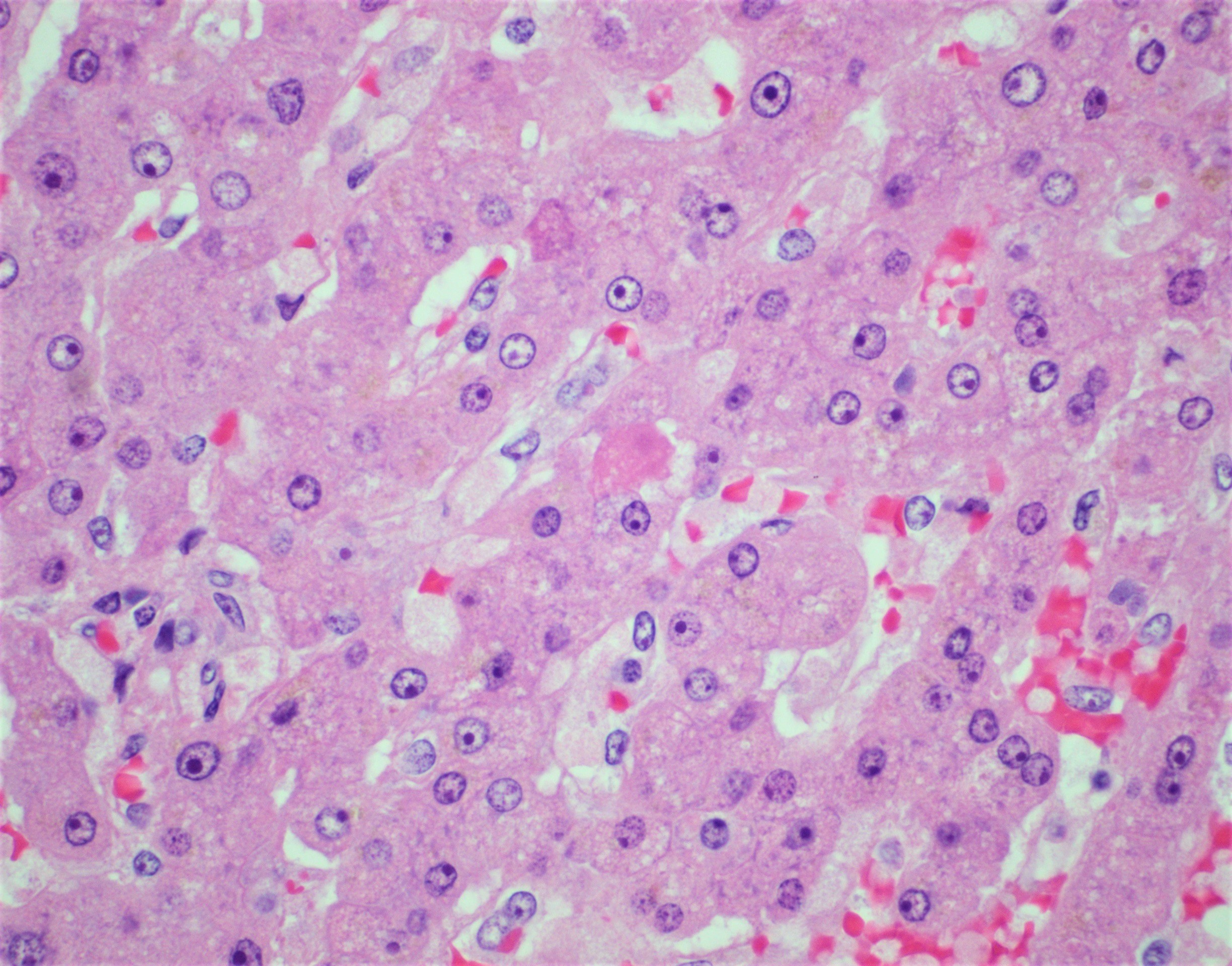 Apoptotic hepatocytes