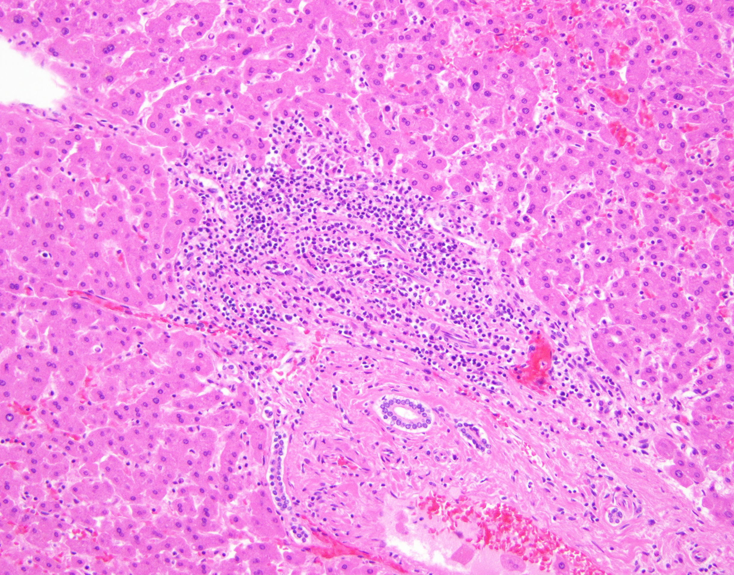 Portal inflammation with interface hepatitis