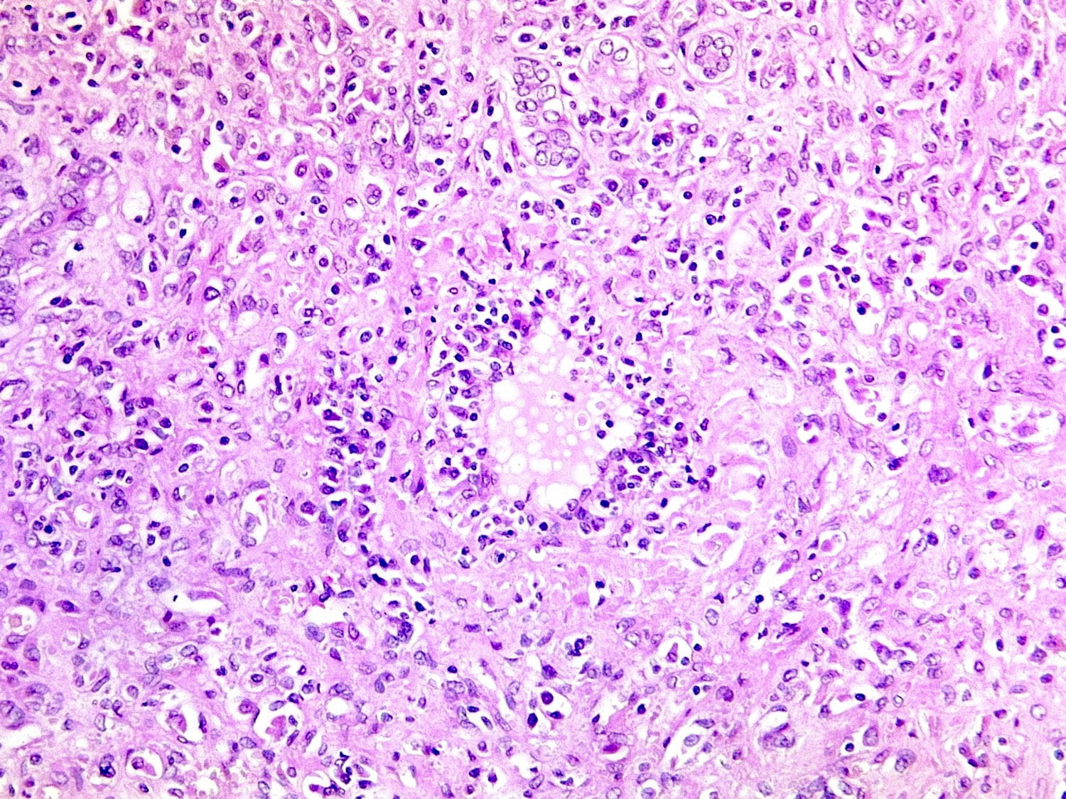 Hathothane associated hepatocellular necrosis