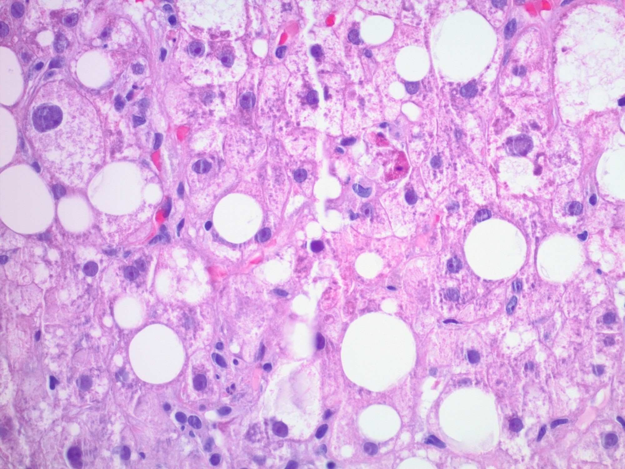 Hepatocyte damage