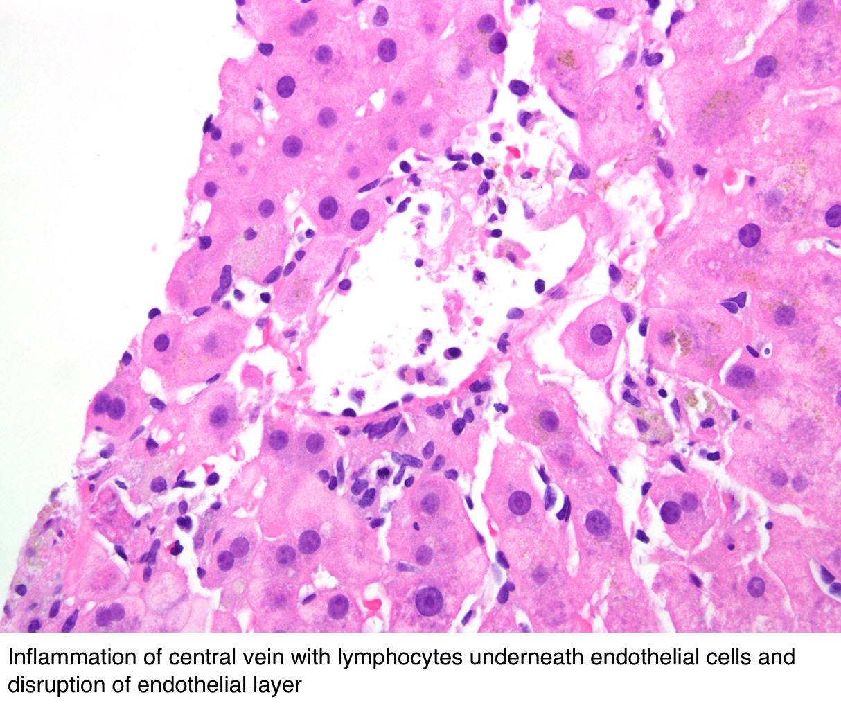 Pathology Outlines - Acute T cell mediated rejection