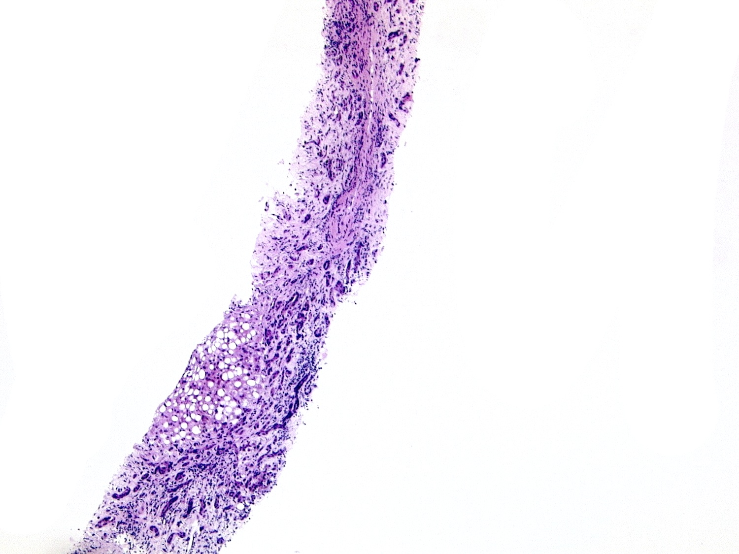 Micronodular cirrhosis