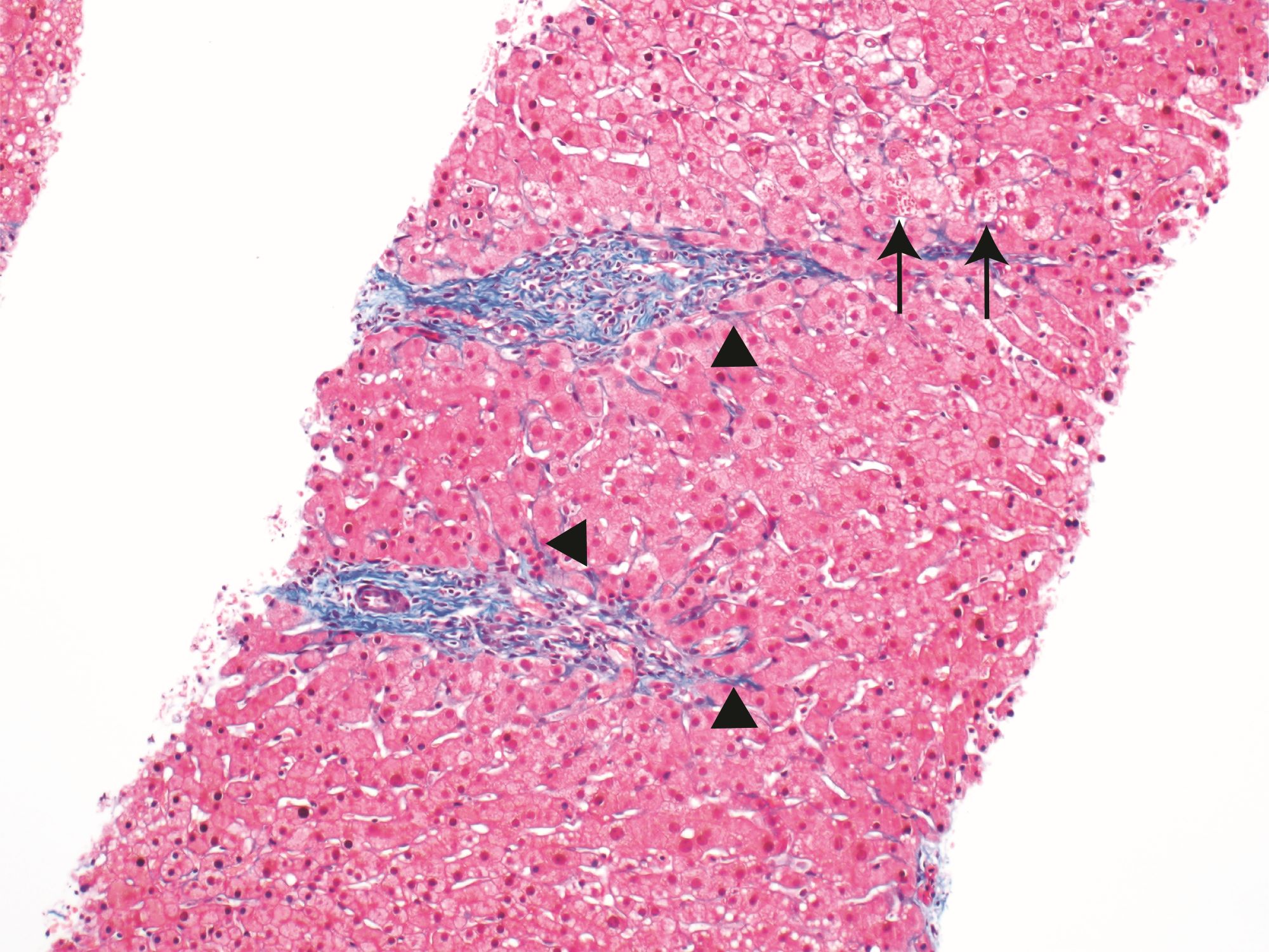 Periportal fibrosis in A1AT