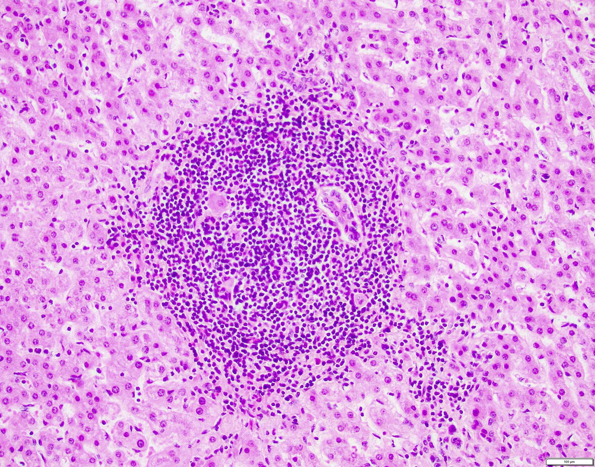 HCV portal lymphoid aggregate