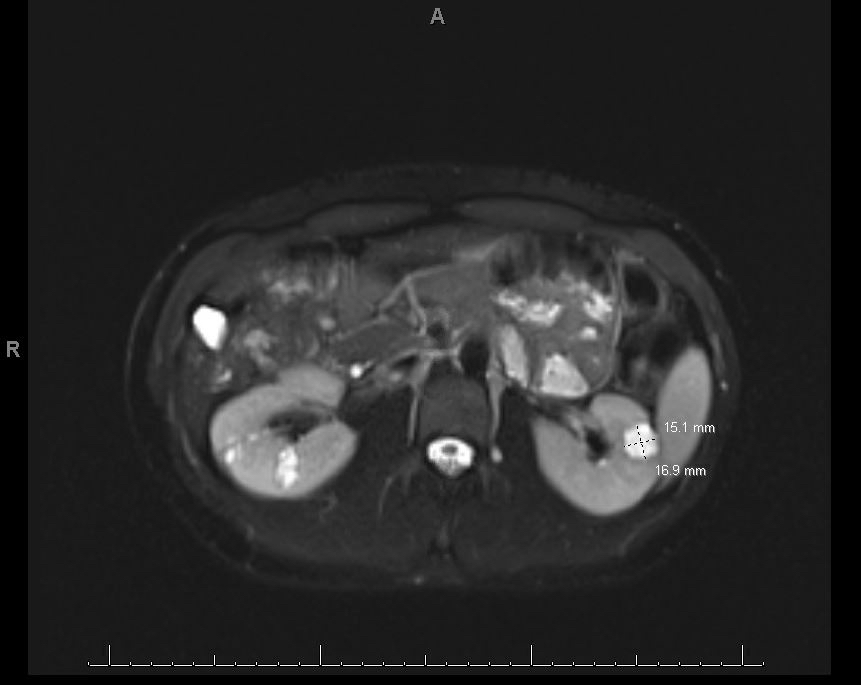 MR abdomen in a patient with Caroli syndrome