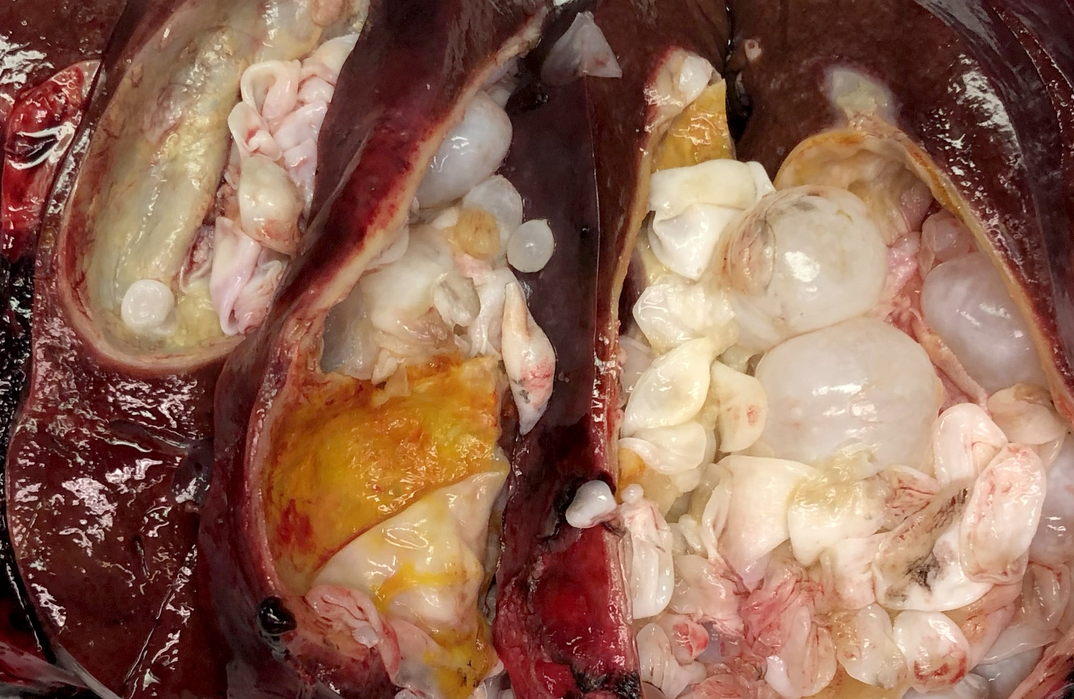 Gross section of hydatid cyst