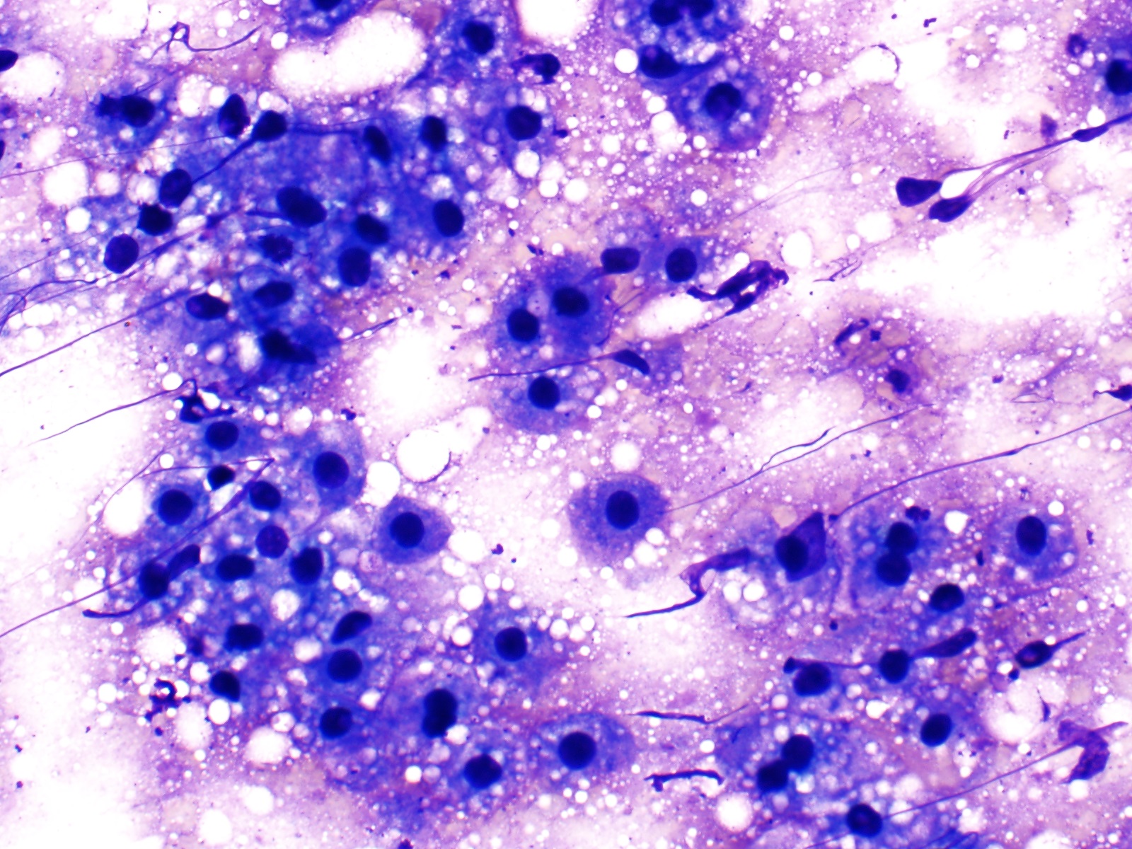 Benign hepatocytes, Diff-Quik