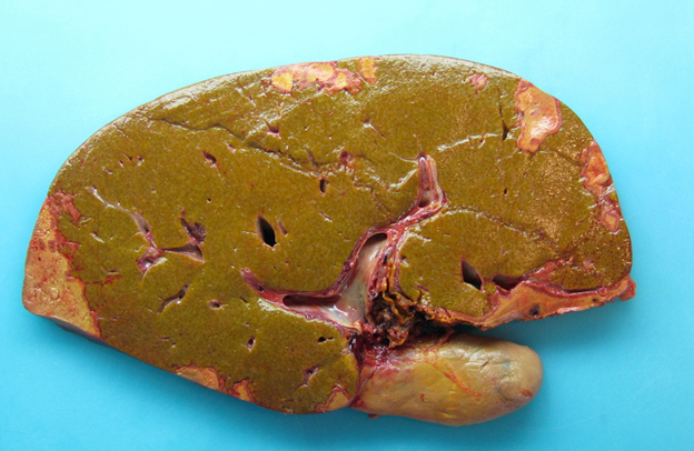 Liver necrosis cut section