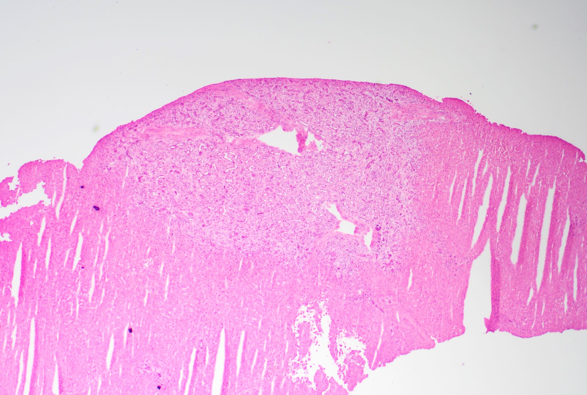 Well circumscribed unencapsulated lesion