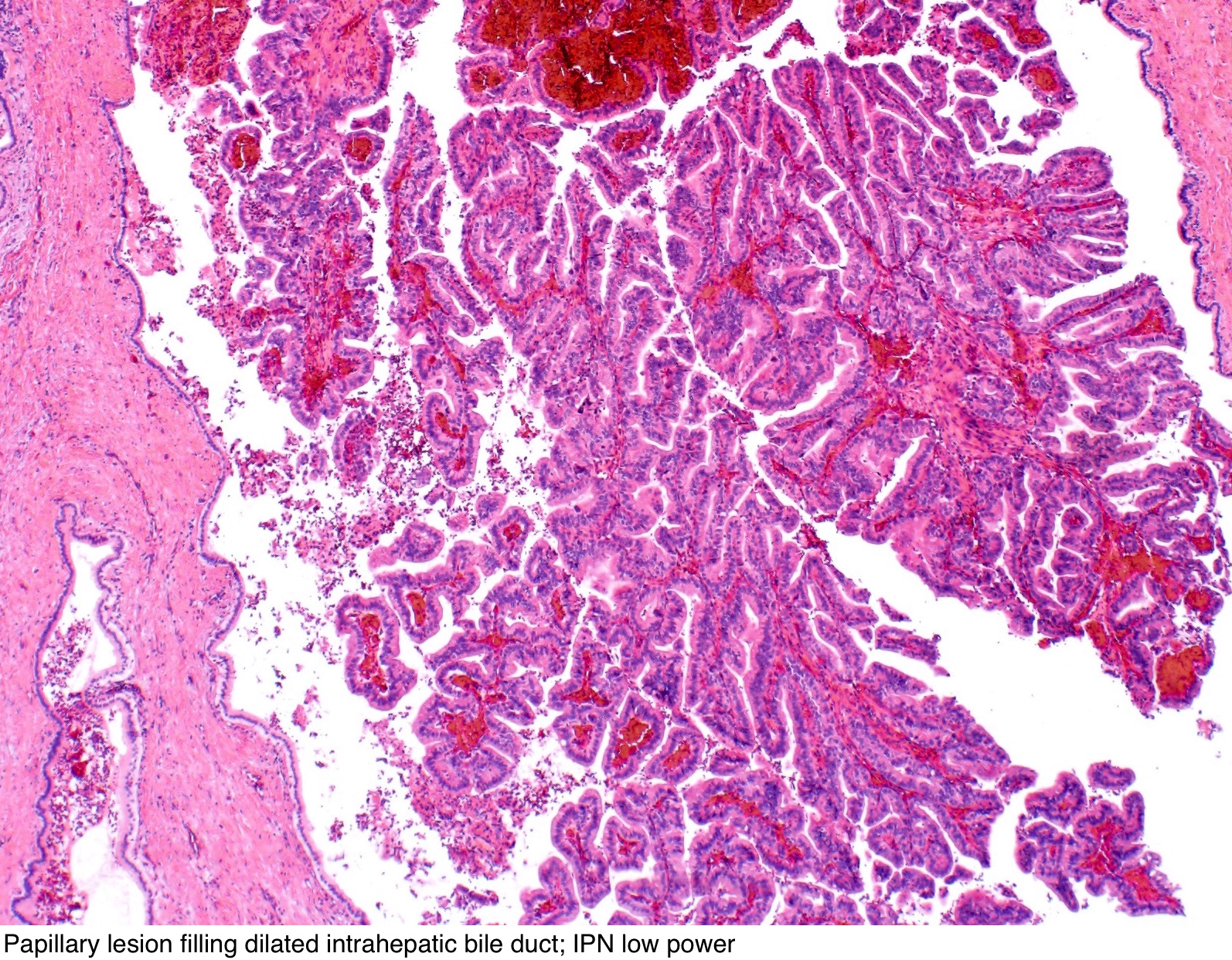 papilloma skin pathology outlines