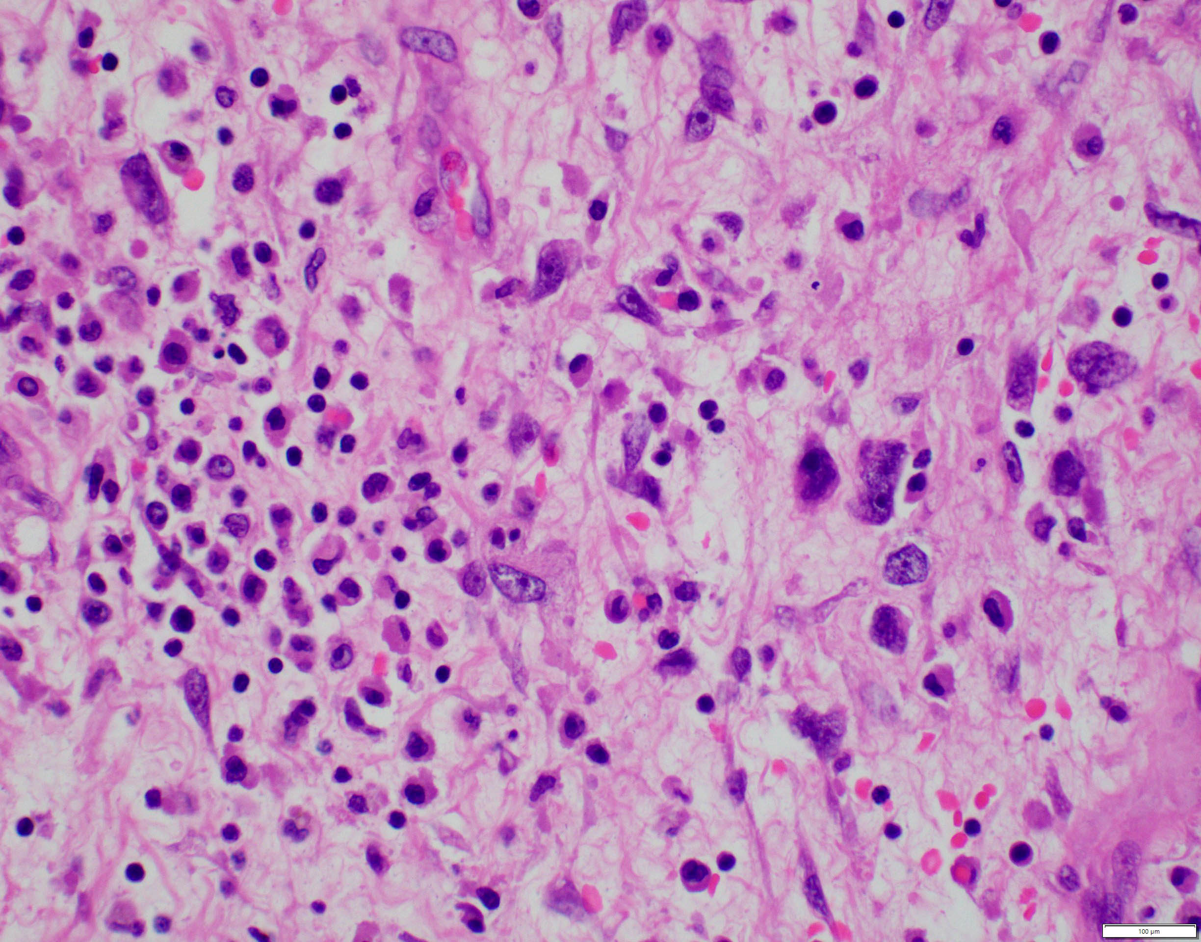 Undifferentiated embryonal sarcoma