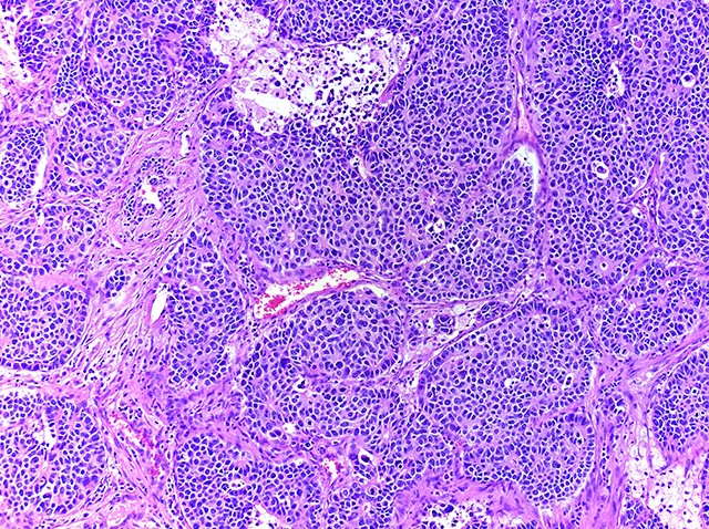 Neuroendocrine cancer lung small cell