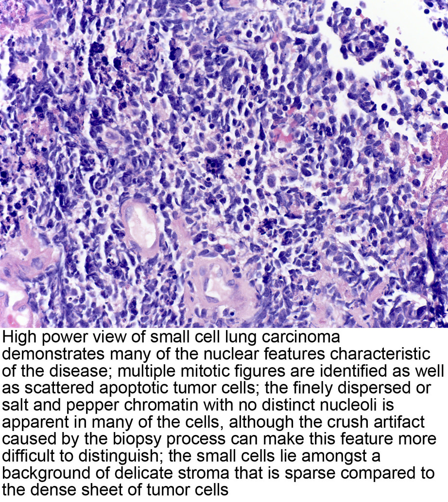 Pathology Outlines Small Cell Carcinoma