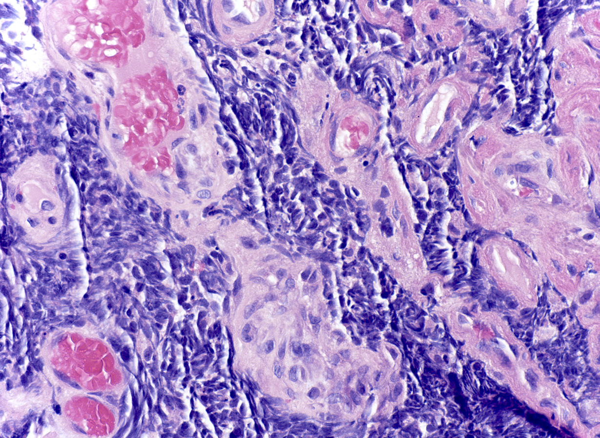 Small Cell Lung Cancer Histology