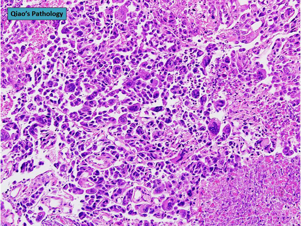 Giant cell carcinoma