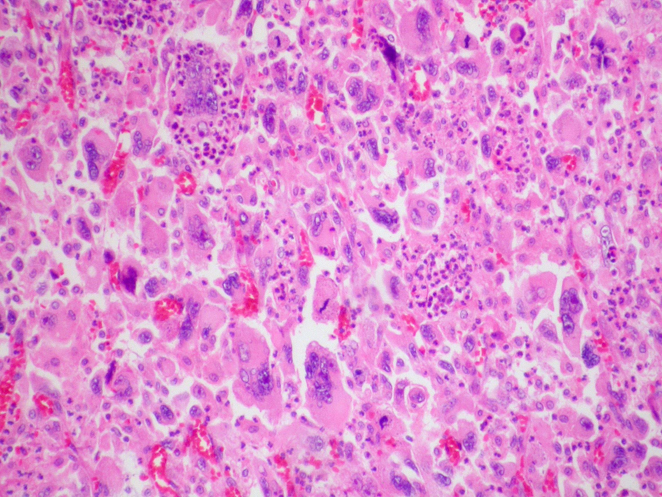 Giant cell carcinoma