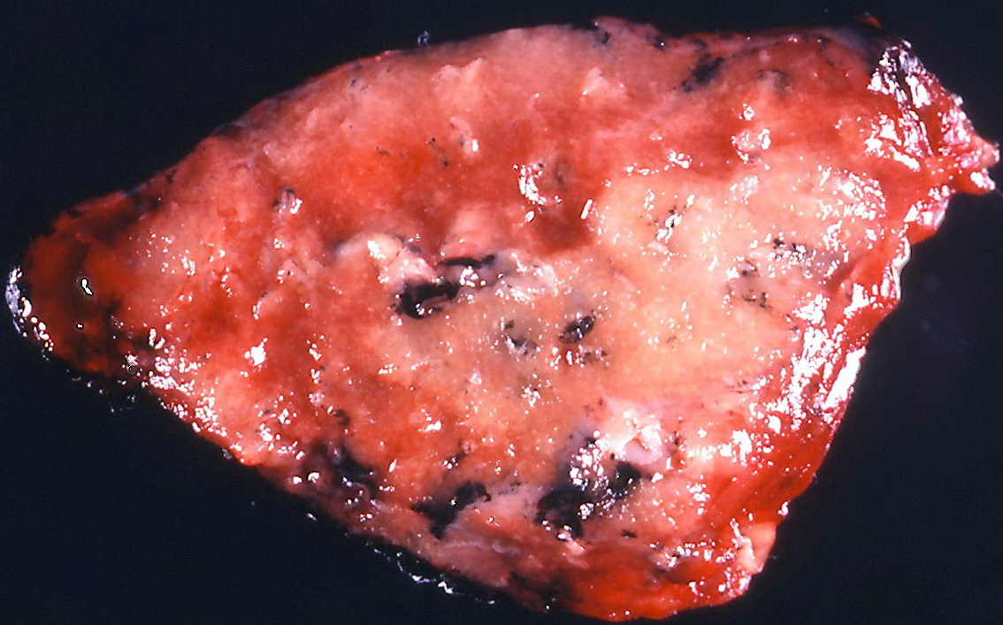 Pale area of nodular consolidation