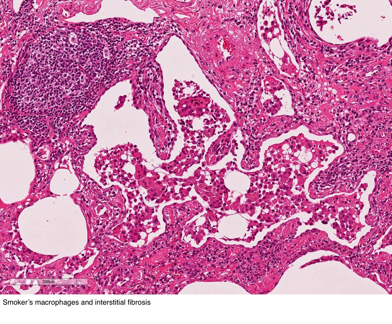 Smoker's macrophages and interstitial fibrosis