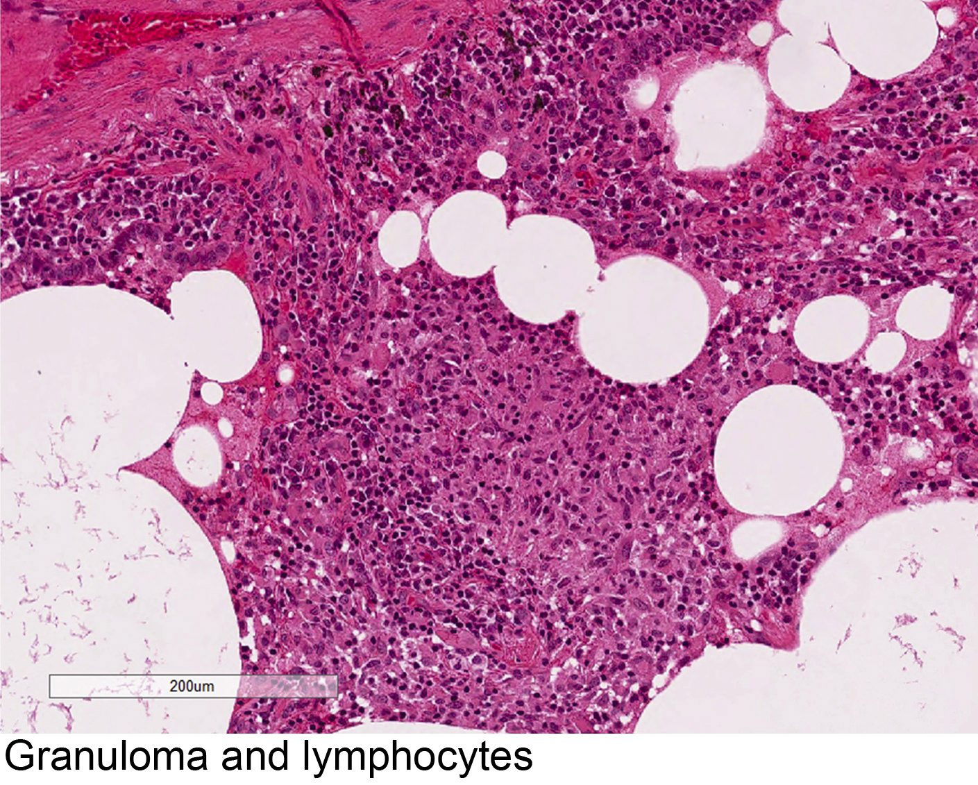 Granuloma and lymphocytes