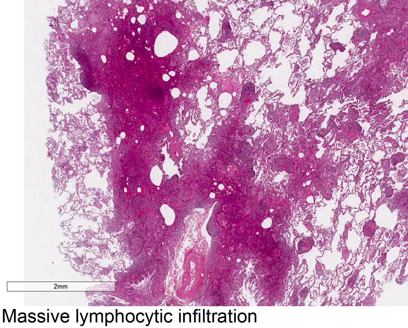 Massive lymphocytic infiltration